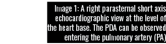 Image 1: A right parasternal short axis echocardiographic view at the level of the heart base  The PDA can be observe   