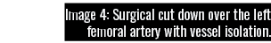Image 4: Surgical cut down over the left femoral artery with vessel isolation 