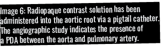 Image 6: Radiopaque contrast solution has been administered into the aortic root via a pigtail catheter  The angiogra   