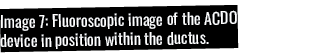 Image 7: Fluoroscopic image of the ACDO device in position within the ductus 