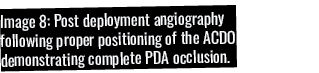 Image 8: Post deployment angiography following proper positioning of the ACDO demonstrating complete PDA occlusion 