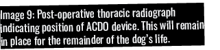 Image 9: Post-operative thoracic radiograph indicating position of ACDO device  This will remain in place for the rem   
