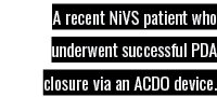 A recent NiVS patient who underwent successful PDA closure via an ACDO device 