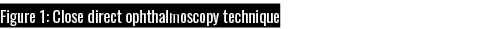 Figure 1: Close direct ophthalmoscopy technique