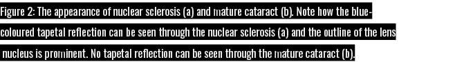 Figure 2: The appearance of nuclear sclerosis (a) and mature cataract (b)  Note how the blue- coloured tapetal reflec   