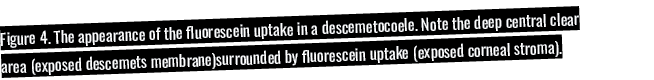 Figure 4  The appearance of the fluorescein uptake in a descemetocoele  Note the deep central clear area (exposed des   