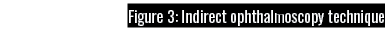 Figure 3: Indirect ophthalmoscopy technique
