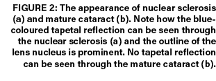 Figure 2: The appearance of nuclear sclerosis (a) and mature cataract (b). Note how the blue coloured tapetal reflect...