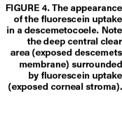 Figure 4. The appearance of the fluorescein uptake in a descemetocoele. Note the deep central clear area (exposed des...