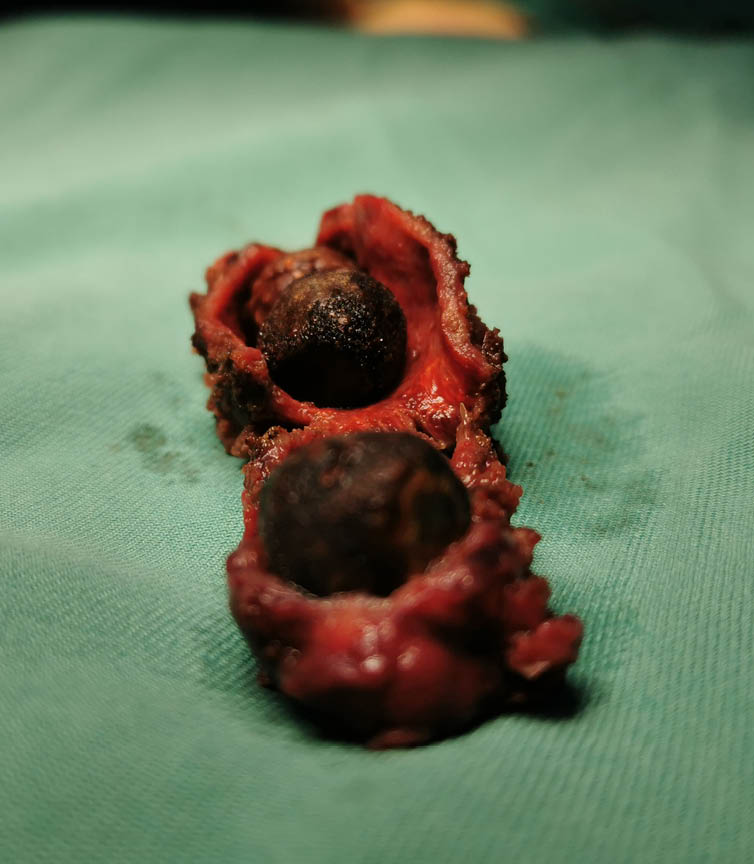 Three infected Gall Bladder Stone removed together via Laparoscopic Cholecystectomy