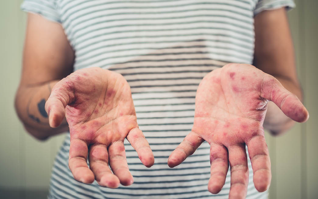 A young man is showing his hands with spots and rash from hand foot and mouth disease
