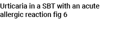 Urticaria in a SBT with an acute allergic reaction fig 6 