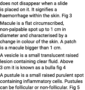 does not disappear when a slide is placed on it. It signifies a haemorrhage within the skin. Fig 3 Macule is a flat c...