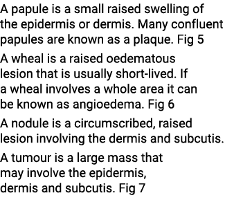 A papule is a small raised swelling of the epidermis or dermis. Many confluent papules are known as a plaque. Fig 5 A...