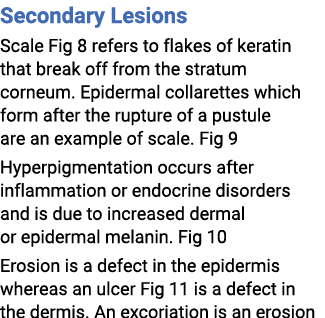Secondary Lesions Scale Fig 8 refers to flakes of keratin that break off from the stratum corneum. Epidermal collaret...