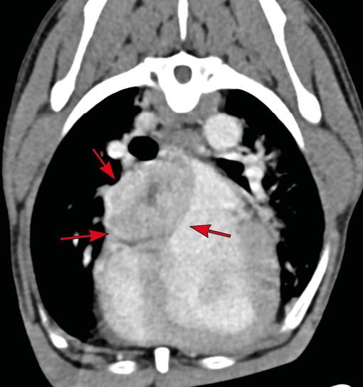 CT scan showing a cross-sectional view of the chest with red arrows pointing to a dense mass in the heart area. Description generated by AI