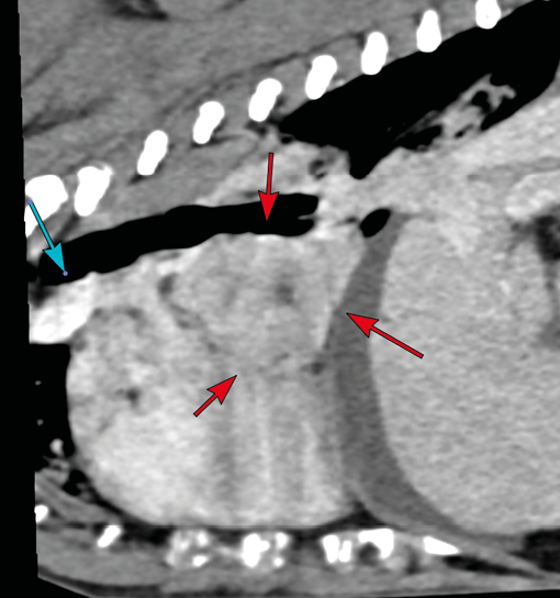 A grayscale medical scan shows internal organs with three red arrows and one blue arrow pointing to specific areas. Description generated by AI