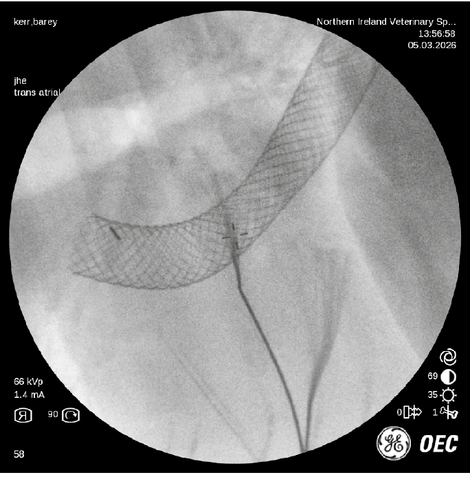 Fluoroscopic image showing a medical stent and catheter inside a blood vessel during a transcatheter procedure. Description generated by AI