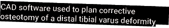 CAD software used to plan corrective osteotomy of a distal tibial varus deformity
