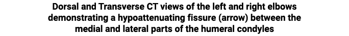 Dorsal and Transverse CT views of the left and right elbows demonstrating a hypoattenuating fissure (arrow) between t...
