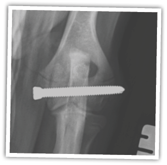 X-ray of a person's shoulder Description automatically generated